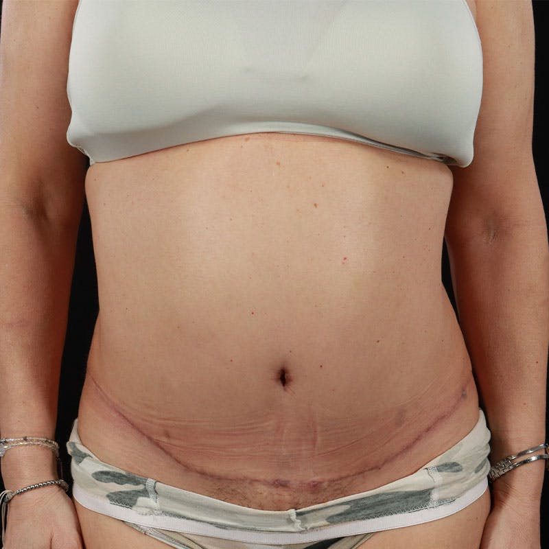 Abdominoplasty (Tummy Tuck) Before & After Gallery - Patient 237438 - Image 2
