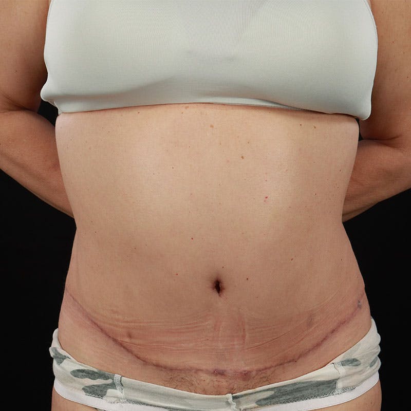 Abdominoplasty (Tummy Tuck) Before & After Gallery - Patient 237438 - Image 4