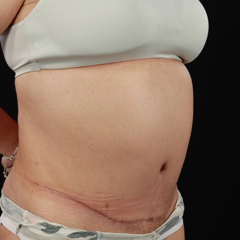 Abdominoplasty (Tummy Tuck) Before & After Gallery - Patient 237438 - Image 6