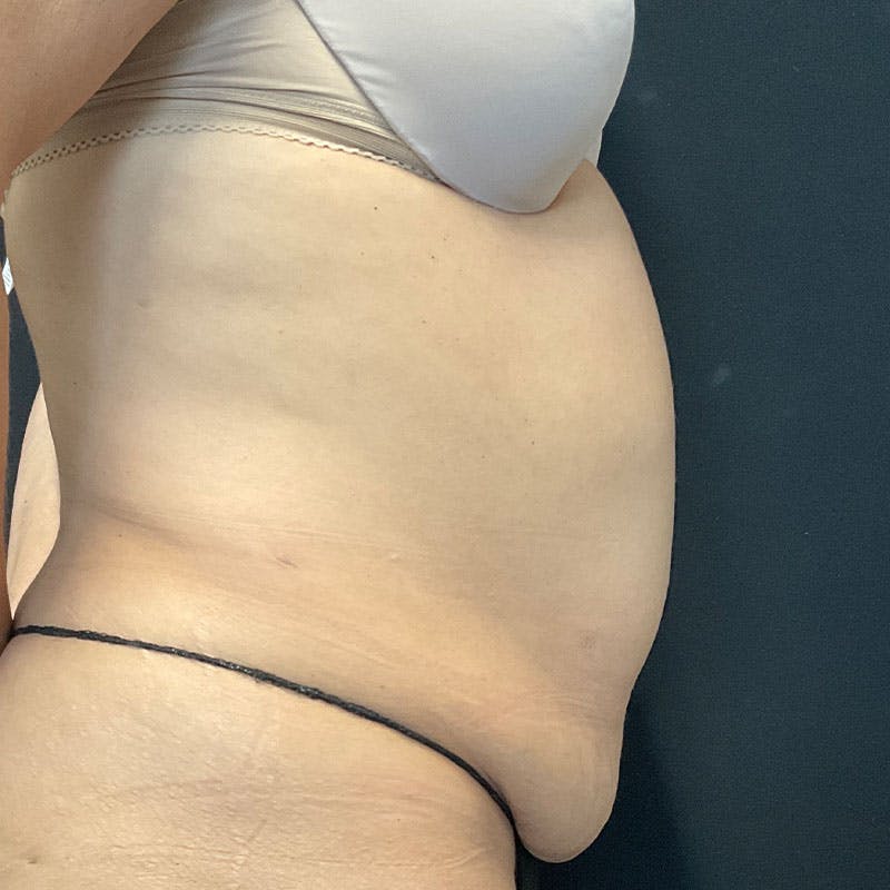 Abdominoplasty (Tummy Tuck) Before & After Gallery - Patient 237438 - Image 7