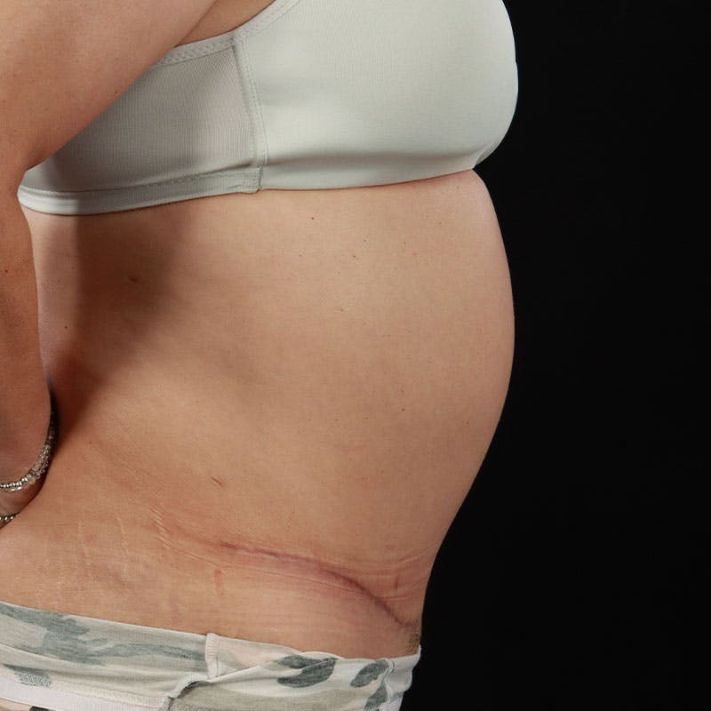 Abdominoplasty (Tummy Tuck) Before & After Gallery - Patient 237438 - Image 8