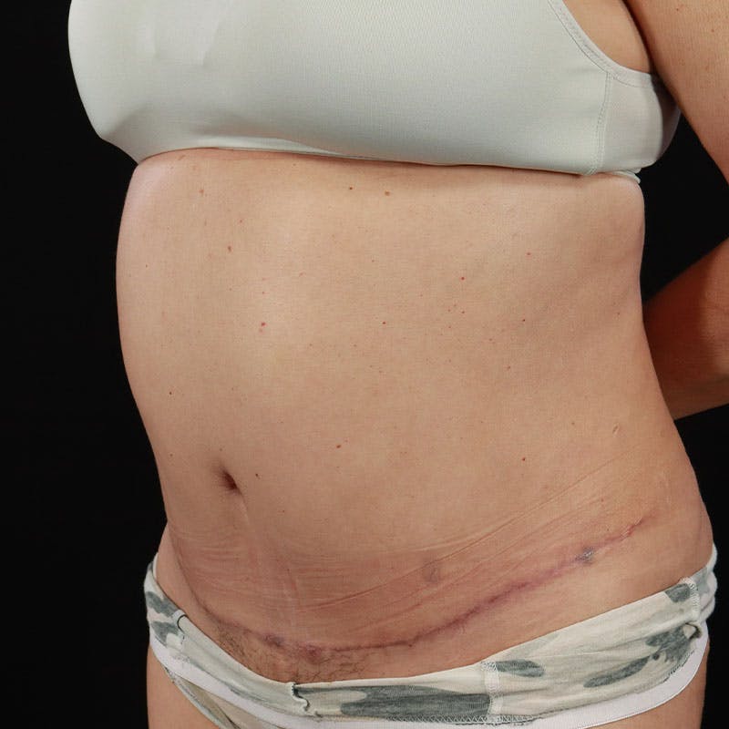 Abdominoplasty (Tummy Tuck) Before & After Gallery - Patient 237438 - Image 12