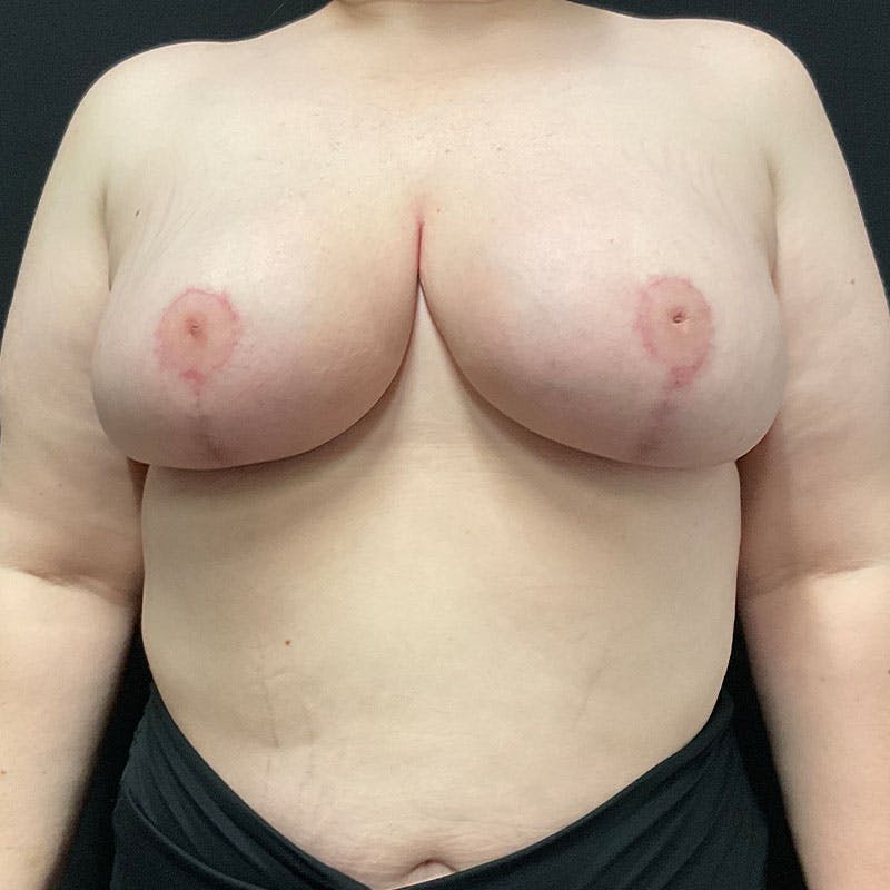 Breast Reduction Before & After Gallery - Patient 293949 - Image 2