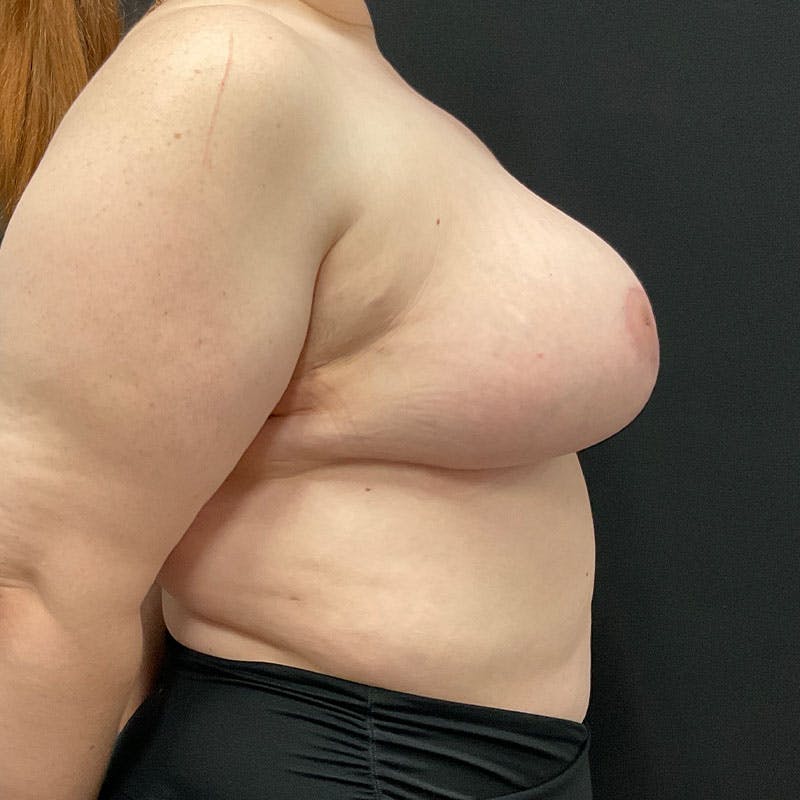 Breast Reduction Before & After Gallery - Patient 293949 - Image 8