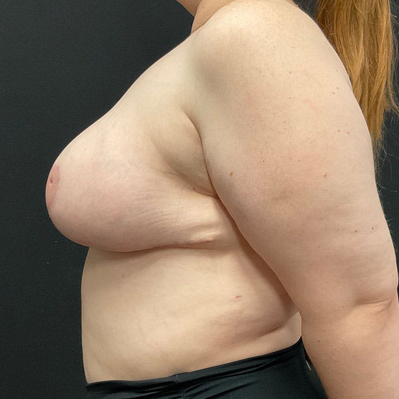Breast Reduction Before & After Gallery - Patient 293949 - Image 10