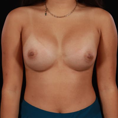 Breast Augmentation Before & After Gallery - Patient 113922 - Image 2