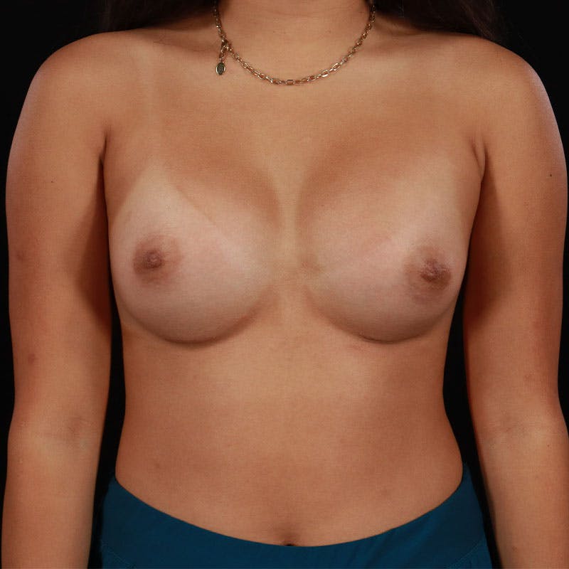 Breast Augmentation Before & After Gallery - Patient 113922 - Image 2
