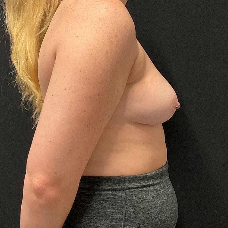Breast Augmentation Before & After Gallery - Patient 322227 - Image 5