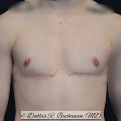 Transgender Top Surgery Before & After Gallery - Patient 197017 - Image 2