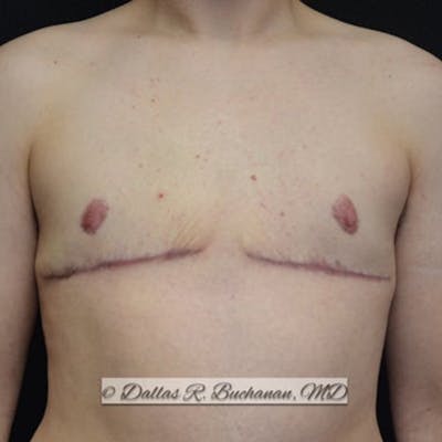 Transgender Top Surgery Before & After Gallery - Patient 572322 - Image 2