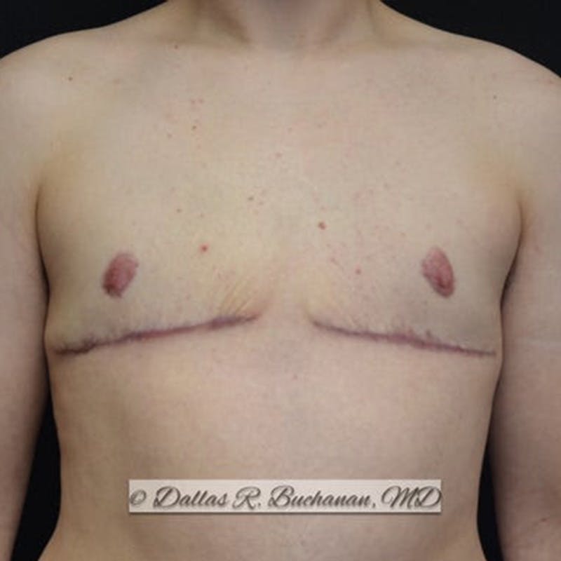 Transgender Top Surgery Before & After Gallery - Patient 572322 - Image 2