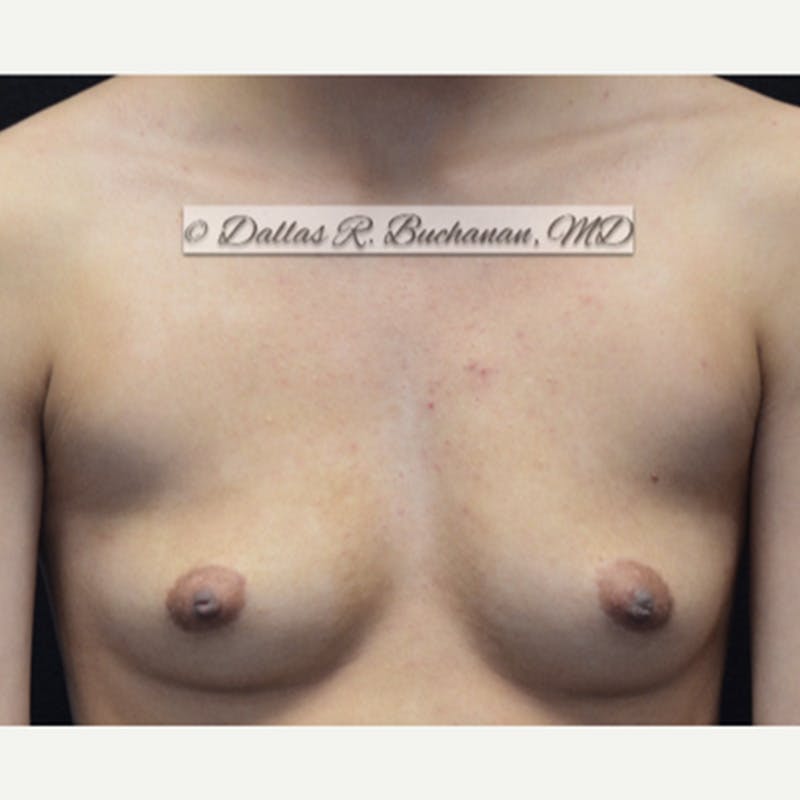 Transgender Top Surgery Before & After Gallery - Patient 290195 - Image 1