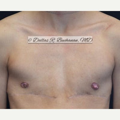 Transgender Top Surgery Before & After Gallery - Patient 290195 - Image 2