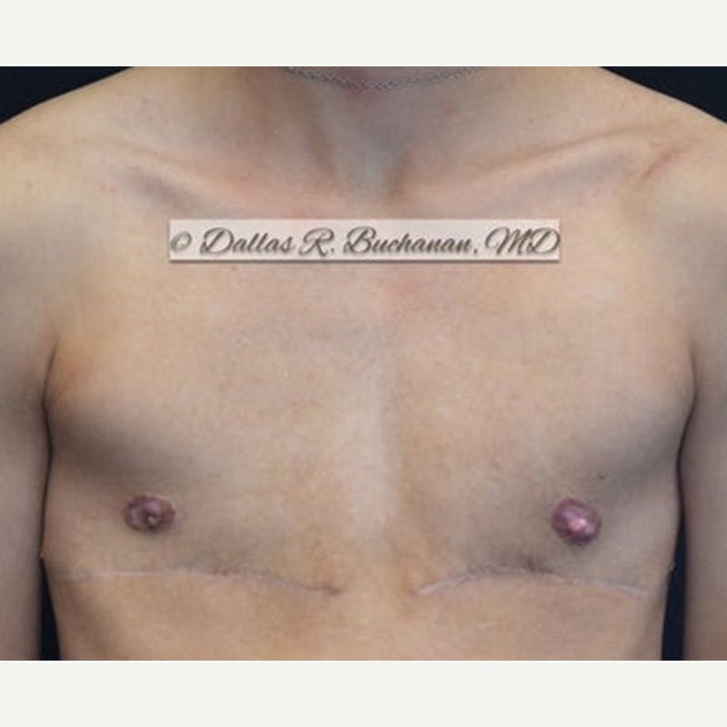 Transgender Top Surgery Before & After Gallery - Patient 290195 - Image 2