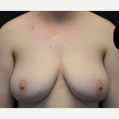 Transgender Top Surgery Before & After Gallery - Patient 227280 - Image 1