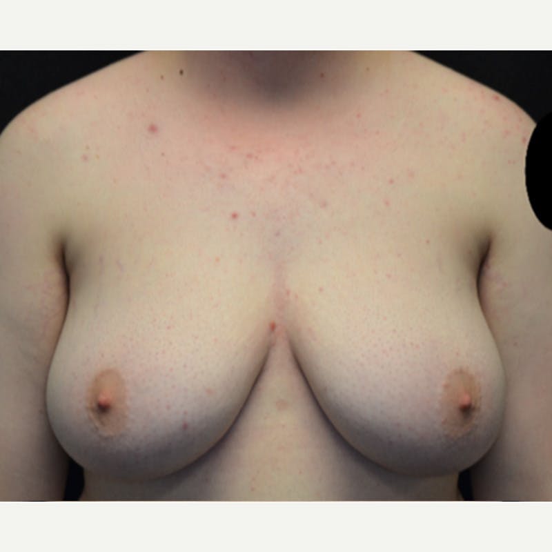 Transgender Top Surgery Before & After Gallery - Patient 227280 - Image 1