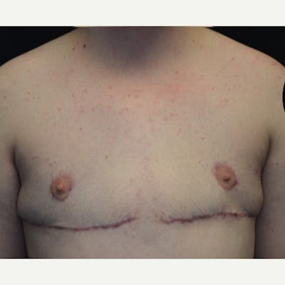 Transgender Top Surgery Before & After Gallery - Patient 227280 - Image 2