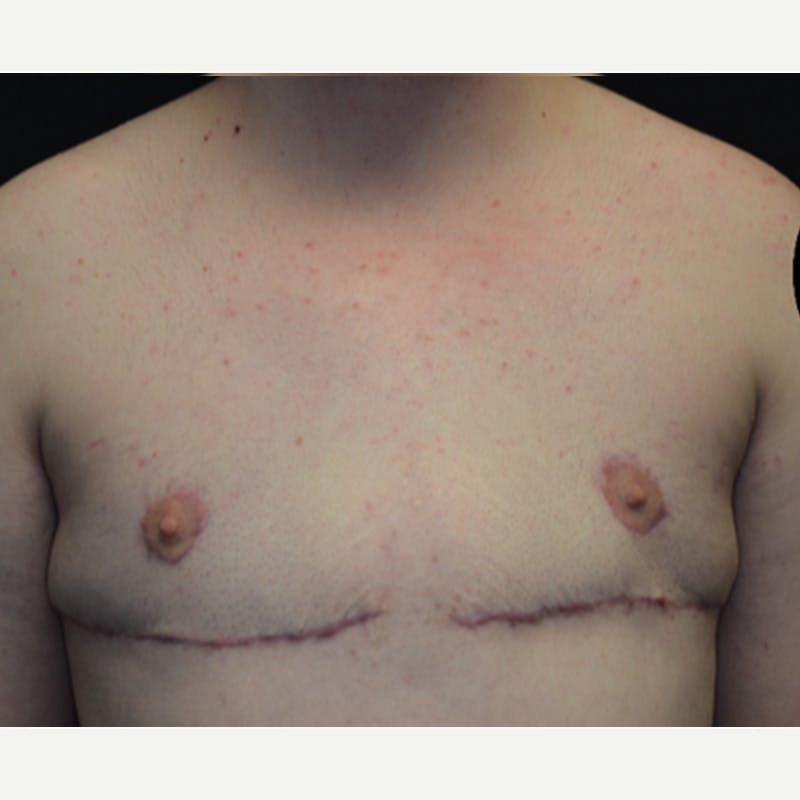 Transgender Top Surgery Before & After Gallery - Patient 227280 - Image 2