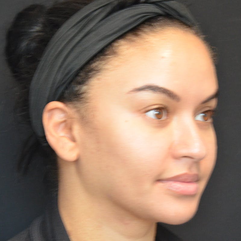 Buccal Fat Pad Removal Before & After Gallery - Patient 103128 - Image 3