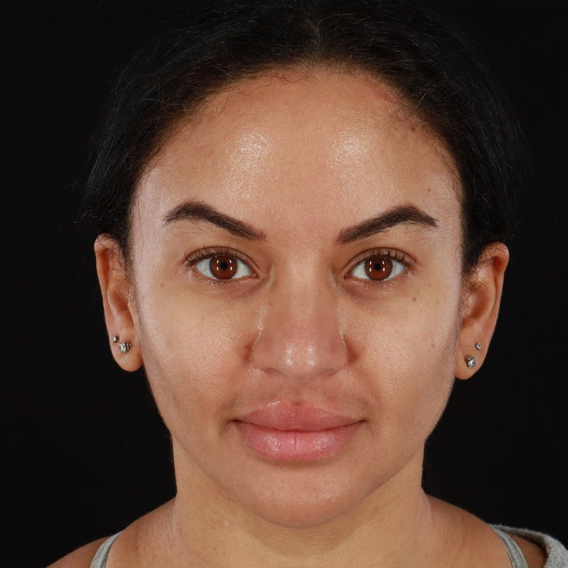 Buccal Fat Pad Removal Before & After Gallery - Patient 103128 - Image 2