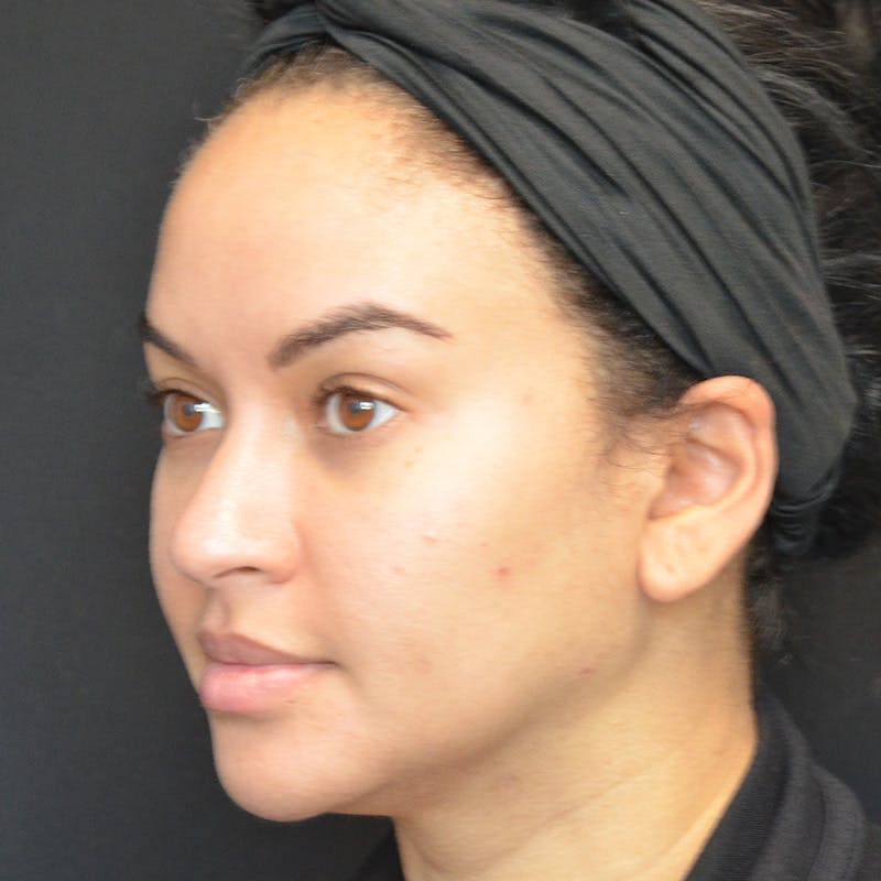 Buccal Fat Pad Removal Before & After Gallery - Patient 103128 - Image 5
