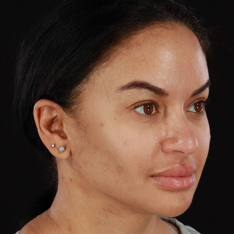 Buccal Fat Pad Removal Before & After Gallery - Patient 103128 - Image 4