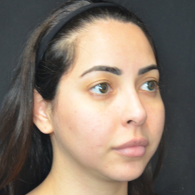 Buccal Fat Pad Removal Before & After Gallery - Patient 167861 - Image 3