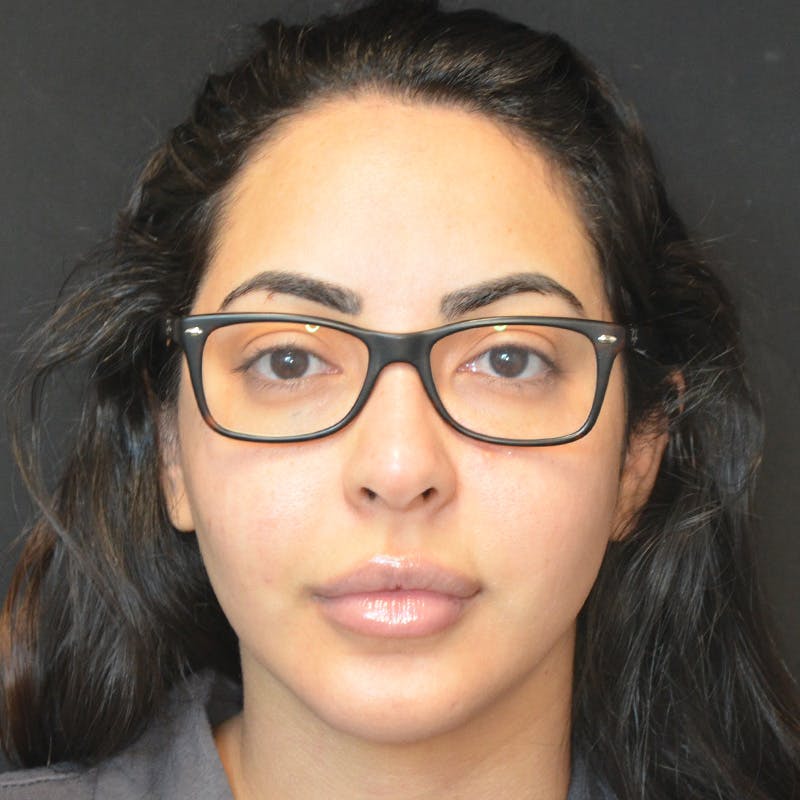 Buccal Fat Pad Removal Before & After Gallery - Patient 167861 - Image 2