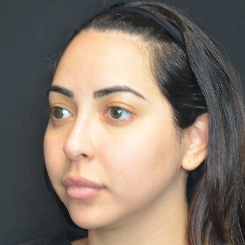 Buccal Fat Pad Removal Before & After Gallery - Patient 167861 - Image 5