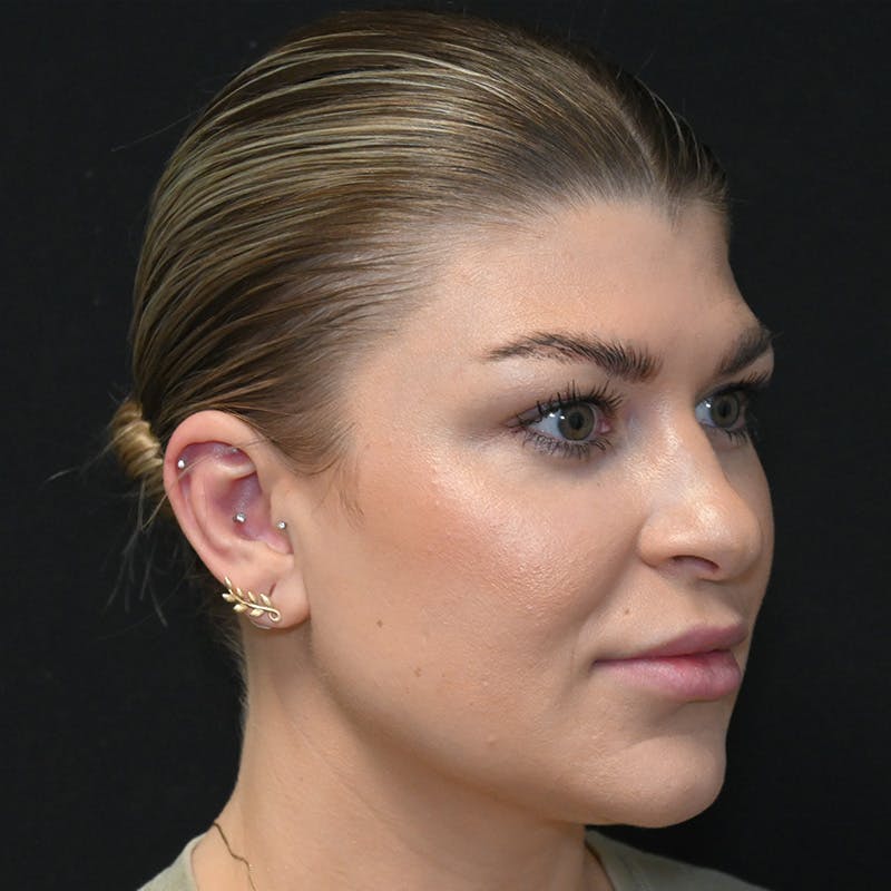 Buccal Fat Pad Removal Before & After Gallery - Patient 182585 - Image 3