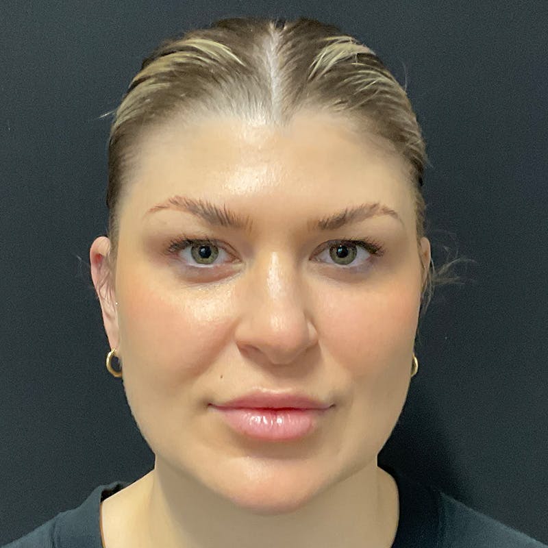 Buccal Fat Pad Removal Before & After Gallery - Patient 182585 - Image 2