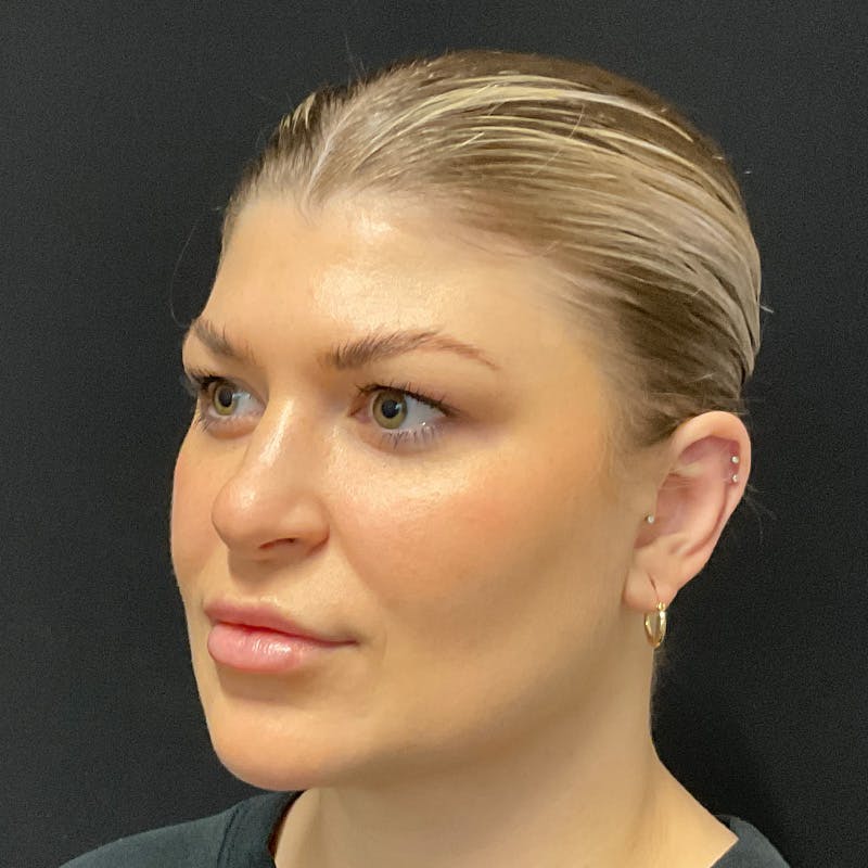 Buccal Fat Pad Removal Before & After Gallery - Patient 182585 - Image 6