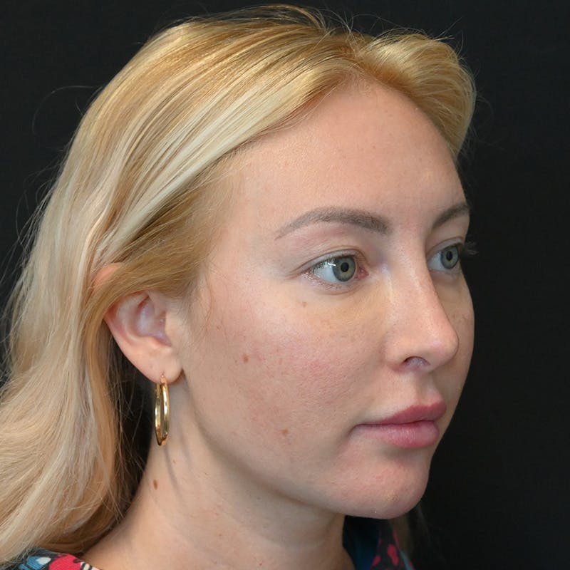 Buccal Fat Pad Removal Before & After Gallery - Patient 400877 - Image 3