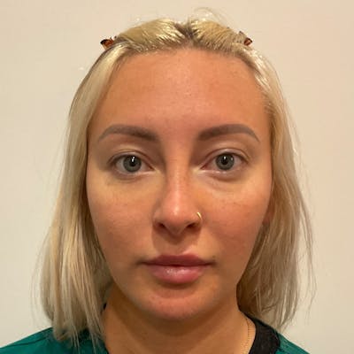 Buccal Fat Pad Removal Before & After Gallery - Patient 400877 - Image 2