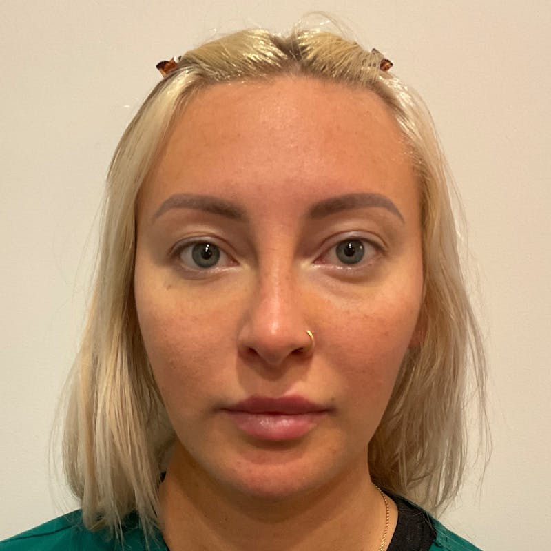 Buccal Fat Pad Removal Before & After Gallery - Patient 400877 - Image 2