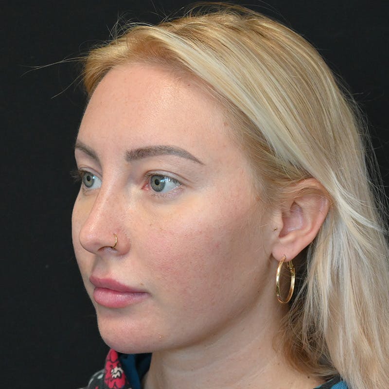 Buccal Fat Pad Removal Before & After Gallery - Patient 400877 - Image 5