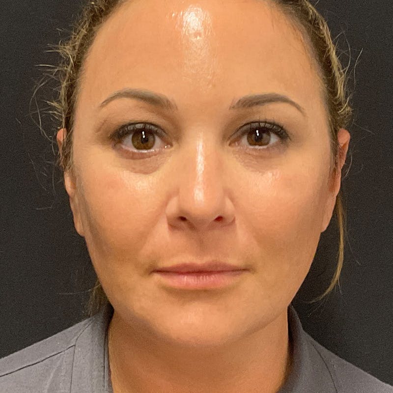 Buccal Fat Pad Removal Before & After Gallery - Patient 194898 - Image 2