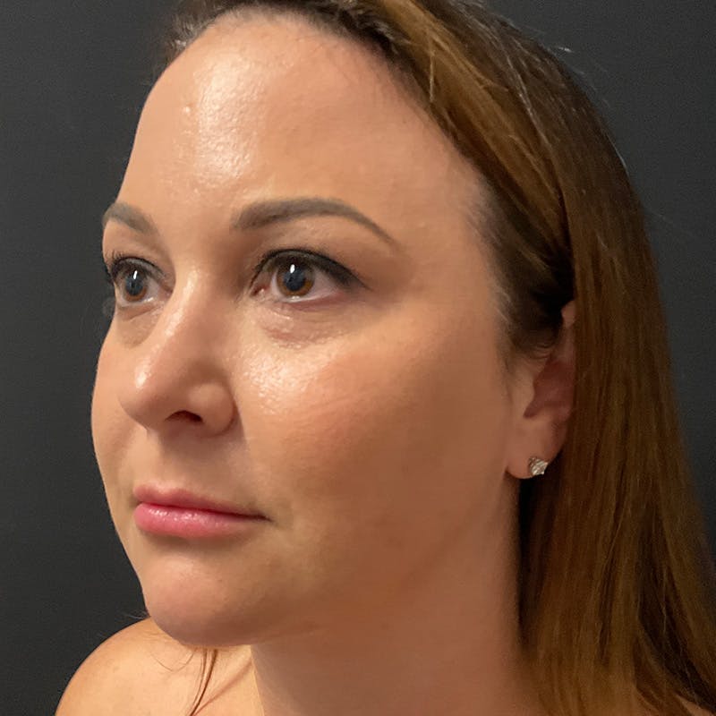 Buccal Fat Pad Removal Before & After Gallery - Patient 194898 - Image 5
