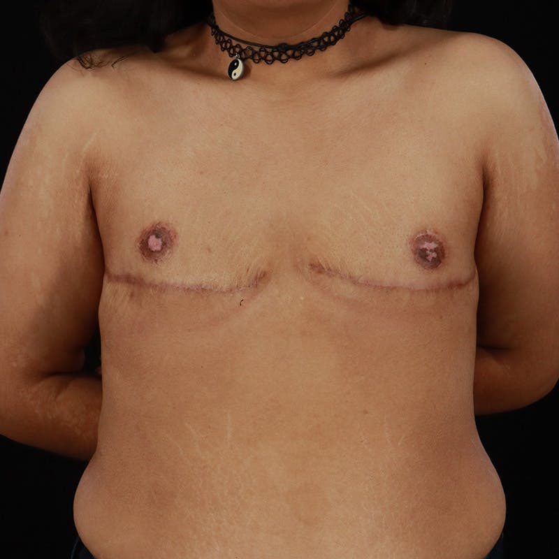 Transgender Top Surgery Before & After Gallery - Patient 171820 - Image 2