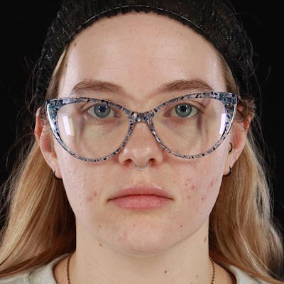 Dermal Fillers Before & After Gallery - Patient 261372 - Image 1