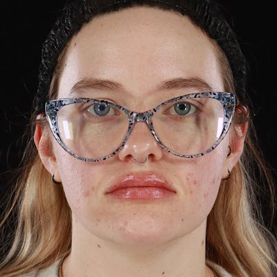 Dermal Fillers Before & After Gallery - Patient 261372 - Image 2