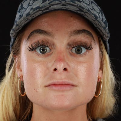 Dermal Fillers Before & After Gallery - Patient 210694 - Image 1