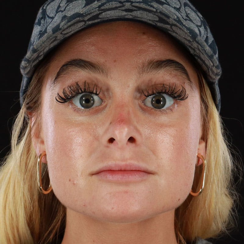 Dermal Fillers Before & After Gallery - Patient 210694 - Image 1