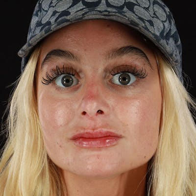 Dermal Fillers Before & After Gallery - Patient 210694 - Image 2