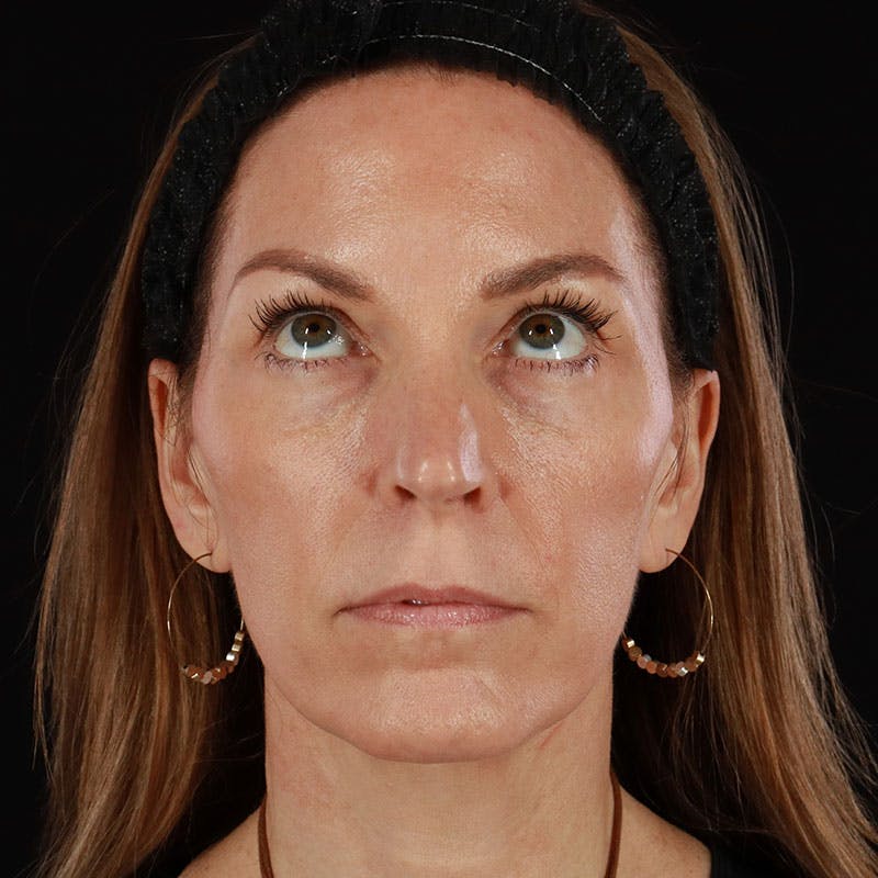 PRP/PRF Therapy Before & After Gallery - Patient 355401 - Image 2