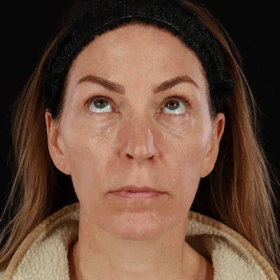 PRP/PRF Therapy Before & After Gallery - Patient 355401 - Image 1