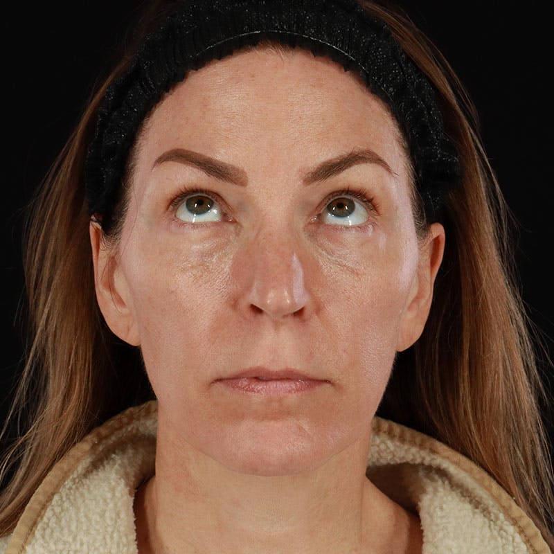 PRP/PRF Therapy Before & After Gallery - Patient 355401 - Image 1