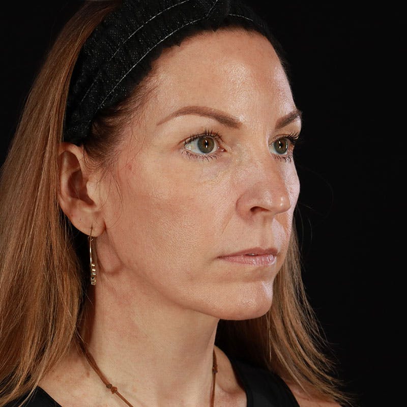 PRP/PRF Therapy Before & After Gallery - Patient 355401 - Image 4