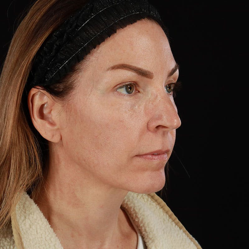 PRP/PRF Therapy Before & After Gallery - Patient 355401 - Image 3