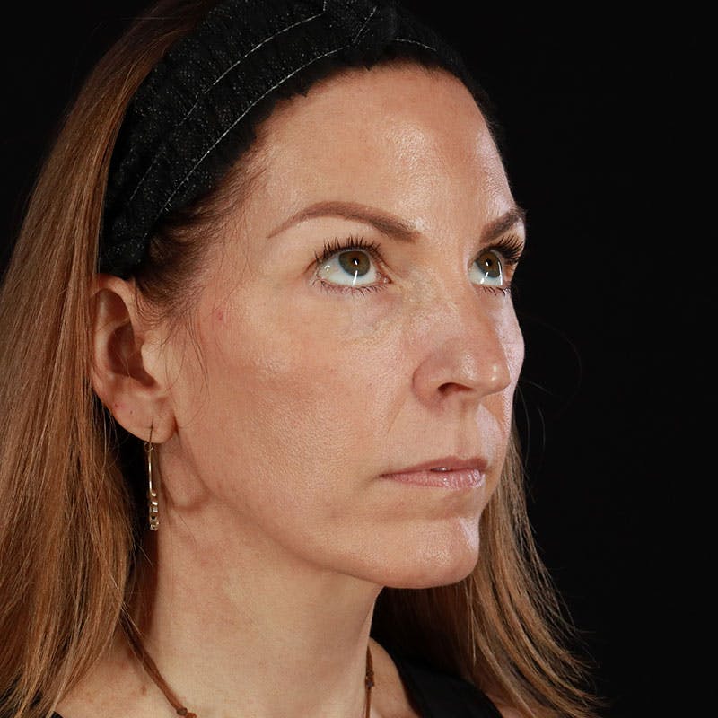 PRP/PRF Therapy Before & After Gallery - Patient 355401 - Image 6